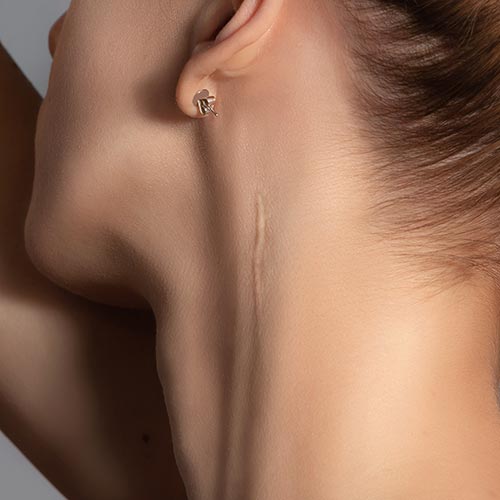 ZABIEG IDEALNY NA BLIZNY PO TRĄDZIKU