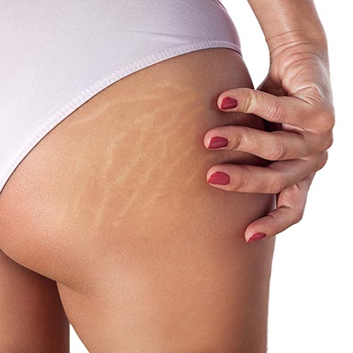 ZABIEG IDEALNY NA BLIZNY PO TRĄDZIKU